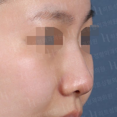 매부리코,비순각,복코교정 나에게 맞는 수술플랜으로! [히트성형외과-한상철원장님] 사진 3