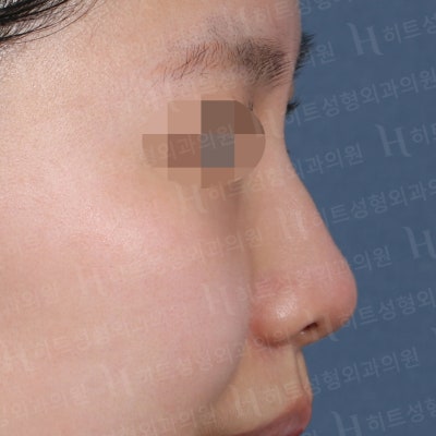 매부리코,비순각,복코교정 나에게 맞는 수술플랜으로! [히트성형외과-한상철원장님] 사진 5