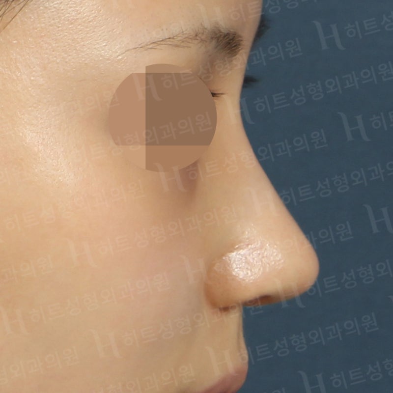 낮은 복코를 카리나코처럼 개선! [히트성형외과] 사진 2
