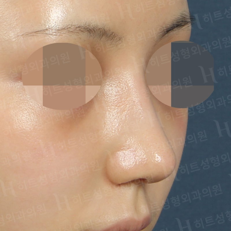 낮은 복코를 카리나코처럼 개선! [히트성형외과] 사진 4