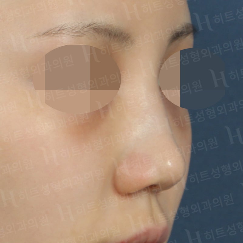 낮은 복코를 카리나코처럼 개선! [히트성형외과] 사진 3