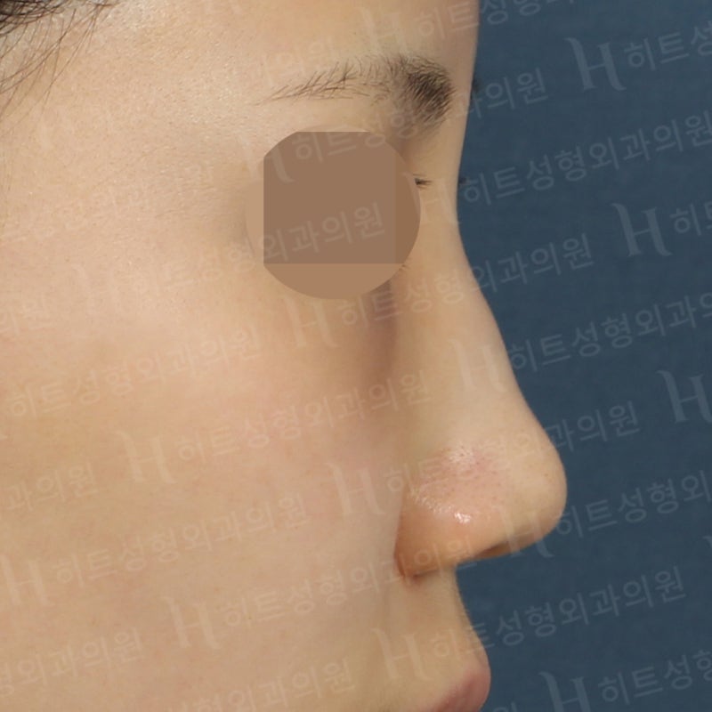 낮은 복코를 카리나코처럼 개선! [히트성형외과]