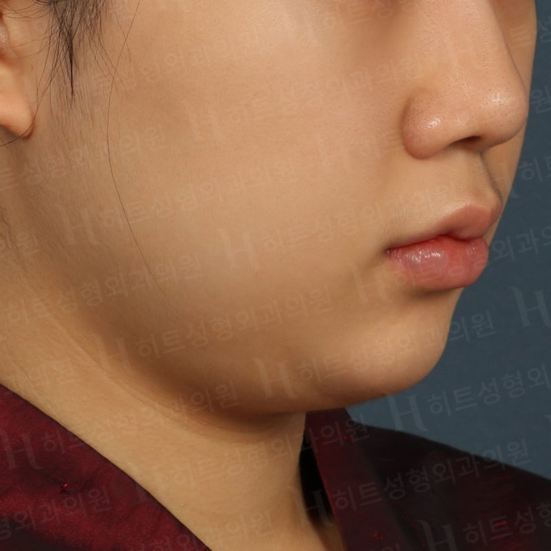 이중턱지방흡입후기 [히트성형외과] 사진 3