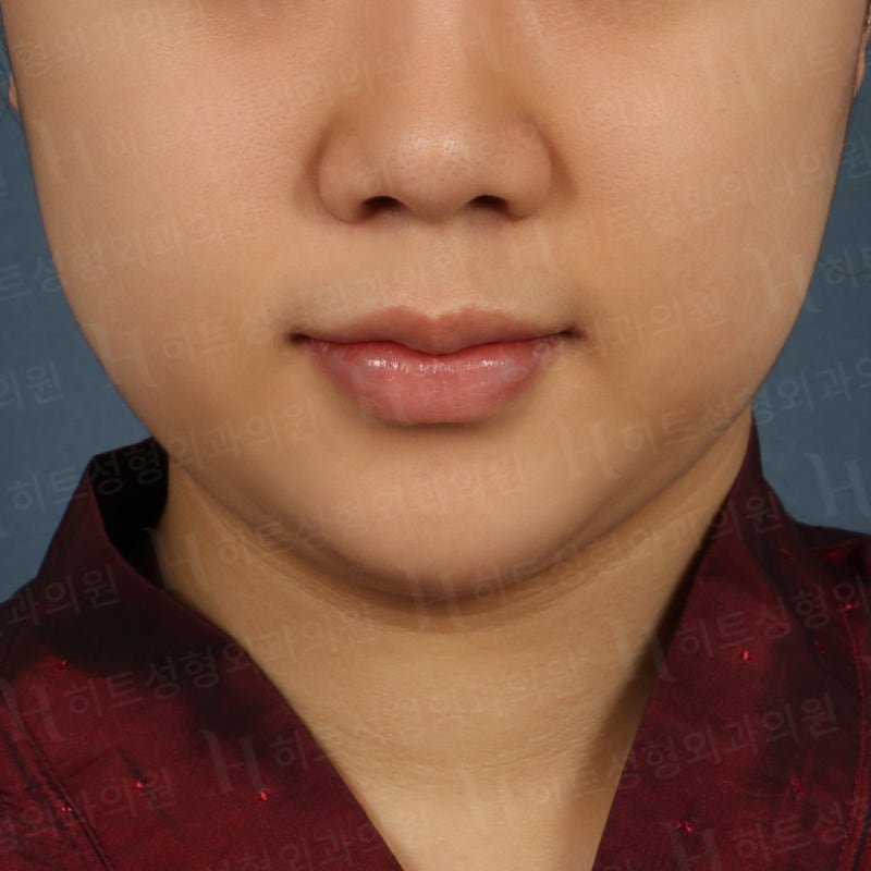 이중턱지방흡입후기 [히트성형외과] 사진 5
