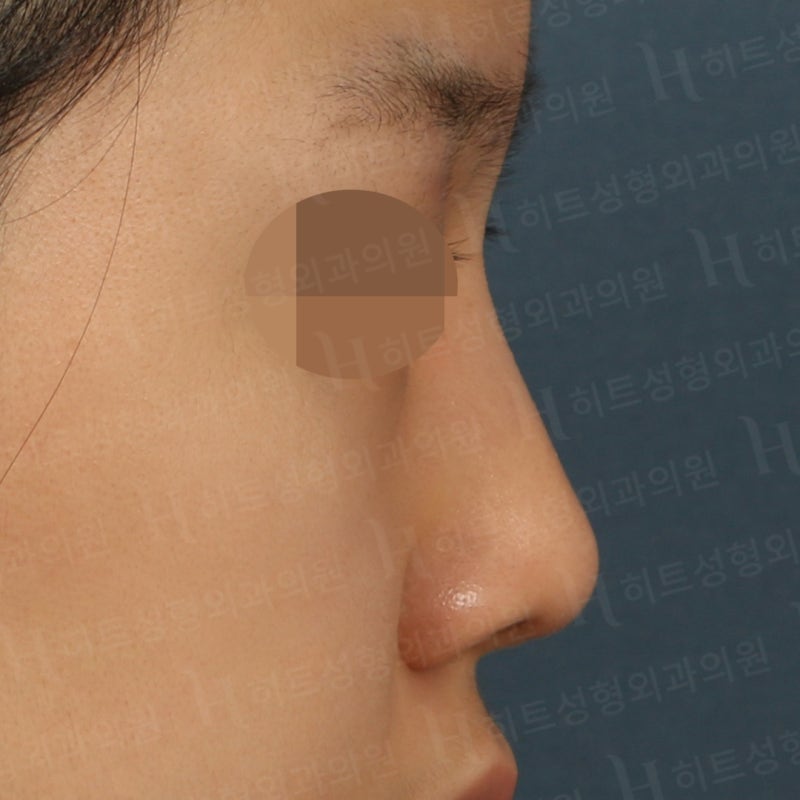 코재수술, 자가늑코수술 케이스 [히트성형외과 - 한상철원장님]