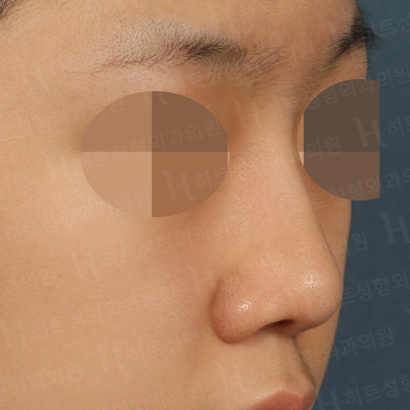 코재수술, 자가늑코수술 케이스 [히트성형외과 - 한상철원장님] 사진 3