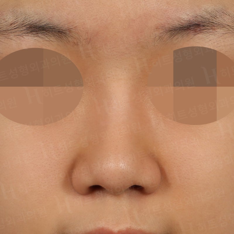 코재수술, 자가늑코수술 케이스 [히트성형외과 - 한상철원장님] 사진 5