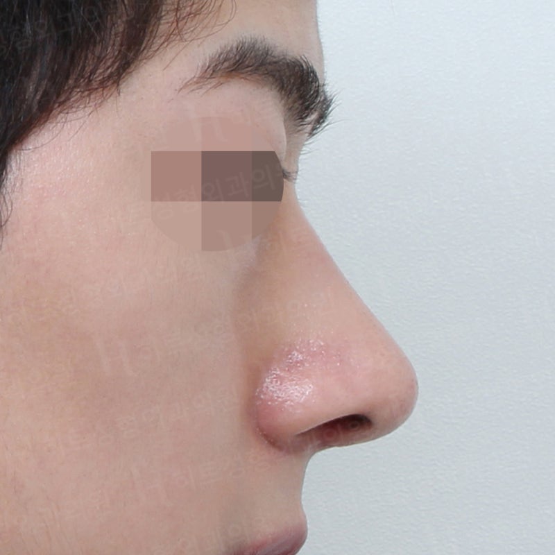 남자코수술전후 코끝만 교정 사례 사진 2