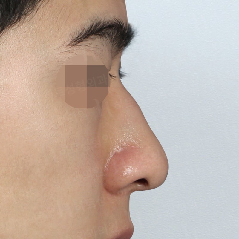 남자코수술전후 코끝만 교정 사례