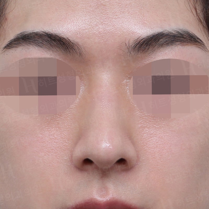 남자코수술전후 코끝만 교정 사례 사진 6
