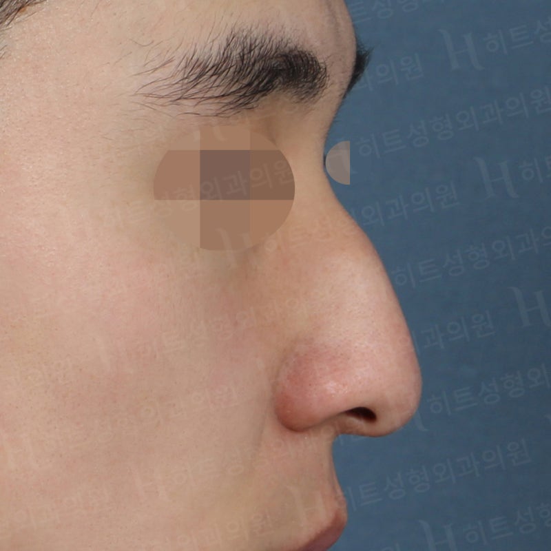 남자코성형 전후, 전형적인 매부리코 사례