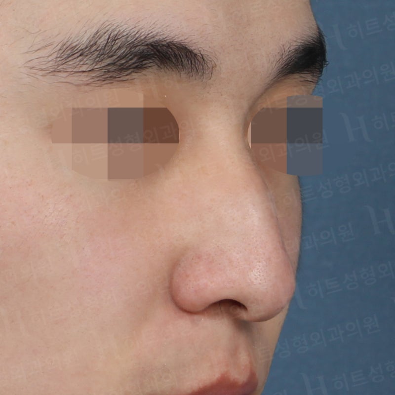 남자코성형 전후, 전형적인 매부리코 사례 사진 3