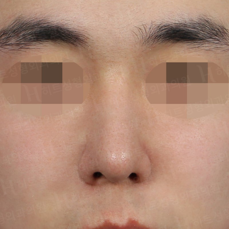 남자코성형 전후, 전형적인 매부리코 사례 사진 6