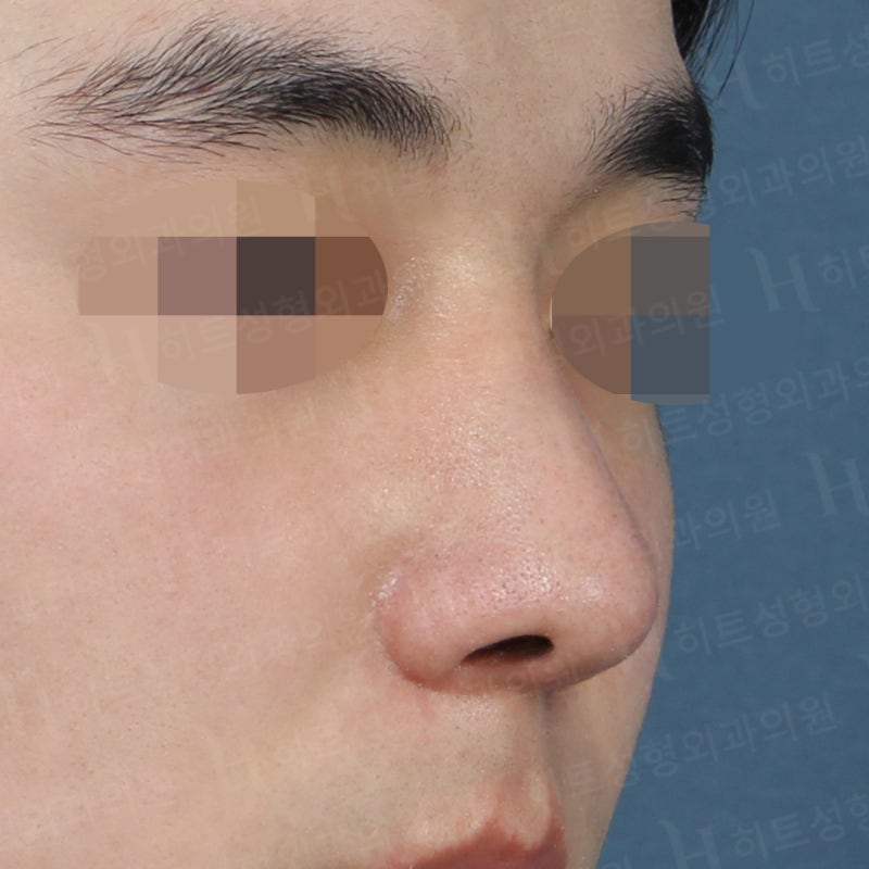 남자코성형 전후, 전형적인 매부리코 사례 사진 4