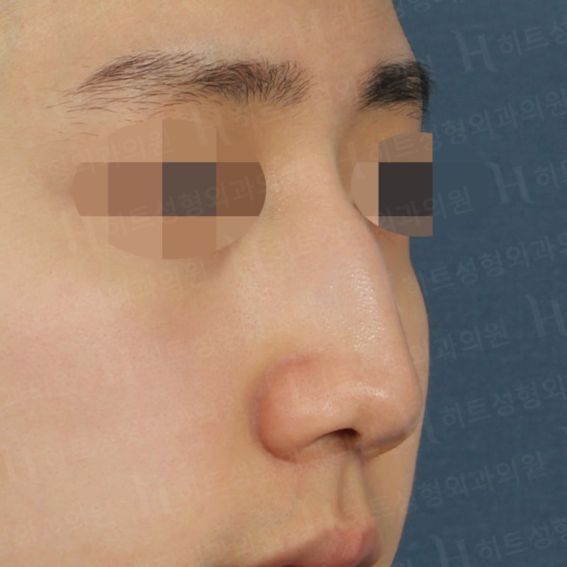 매부리코교정 남자코수술 사례 [히트성형외과] 사진 3