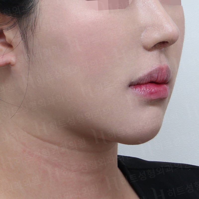 얼굴지방흡입 재수술로 V라인 완성! [히트성형외과] 사진 4