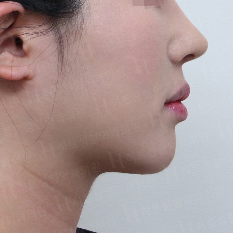 얼굴지방흡입 재수술로 V라인 완성! [히트성형외과] 사진 6