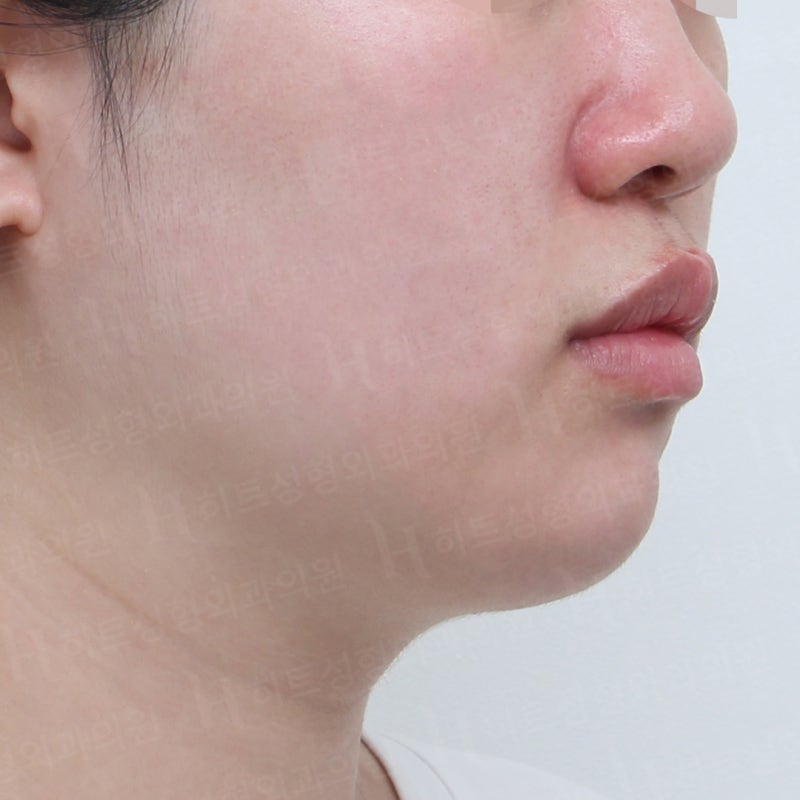 얼굴지방흡입 재수술로 V라인 완성! [히트성형외과] 사진 3