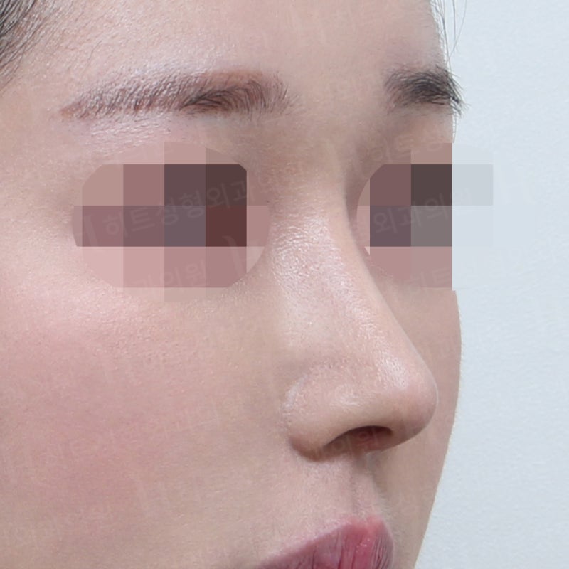 복코교정으로 얄쌍하게! [히트성형외과] 사진 4