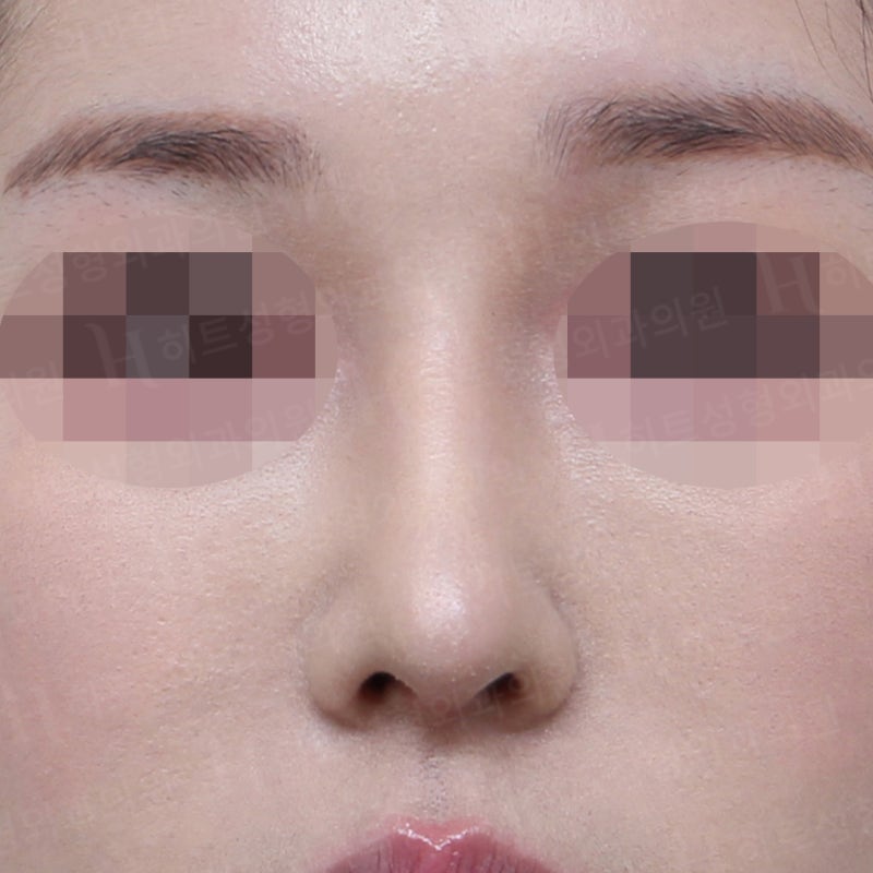 복코교정으로 얄쌍하게! [히트성형외과] 사진 2