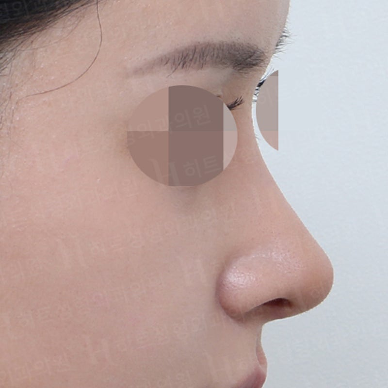 코필러 대신 코수술 하는 이유![히트성형외과] 사진 6