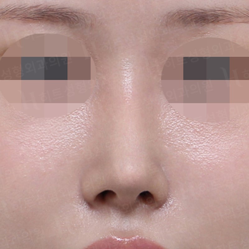 코재수술 사례, 재수술 할 때 중요한 점 사진 6