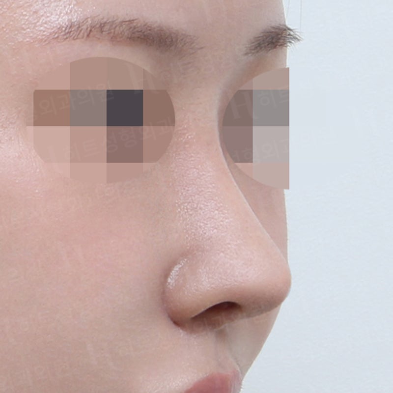 코재수술 사례, 재수술 할 때 중요한 점 사진 4