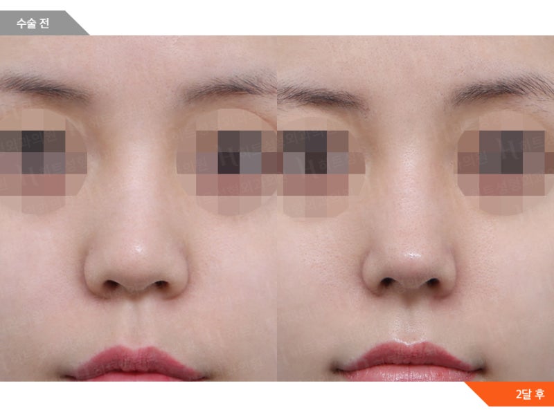 무보형물 코성형으로 원하는 코라인 만들기 (히트성형외과 코끝성형)