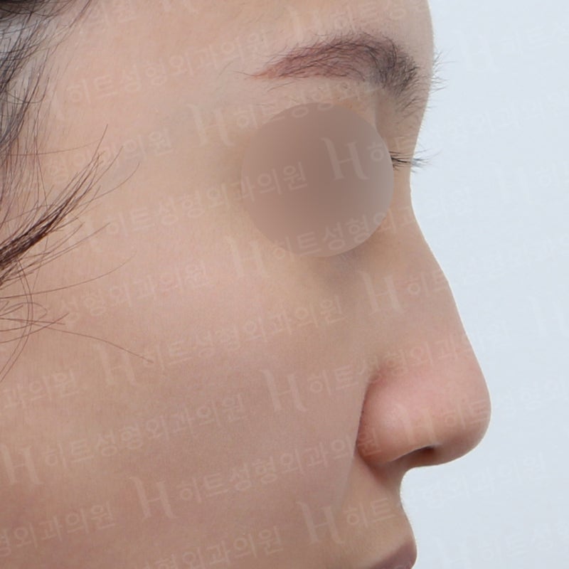복코수술 할 때 도움되는 이것! 사진 5