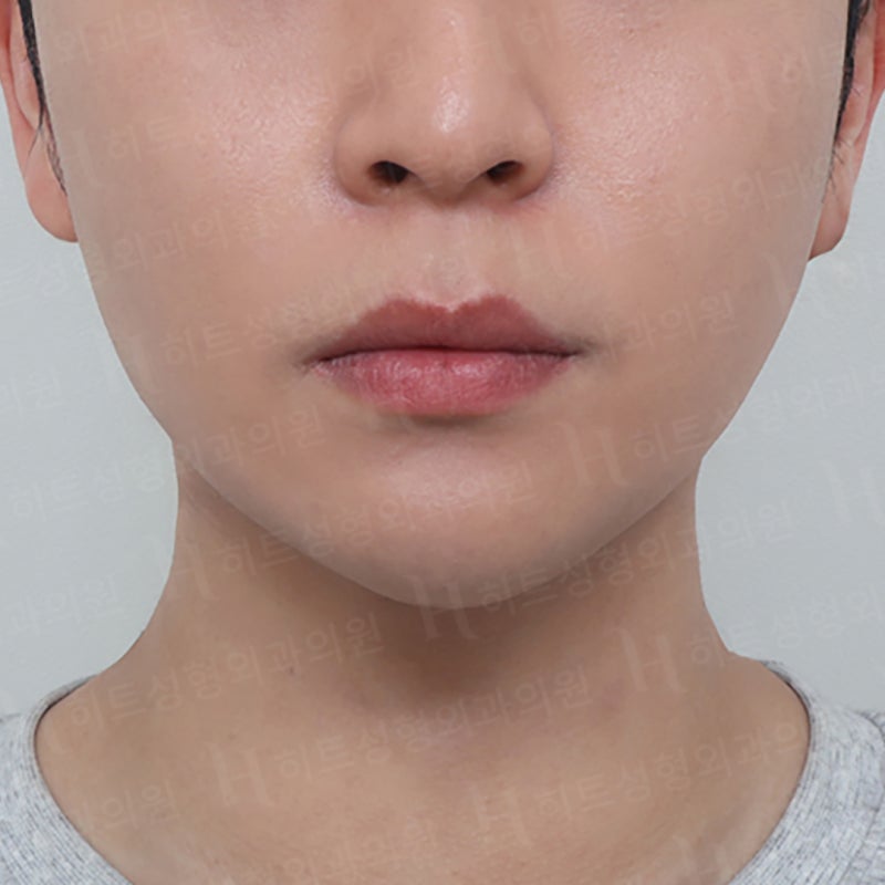 아이돌 얼굴형 만드는 얼굴지방흡입수술 사진 4