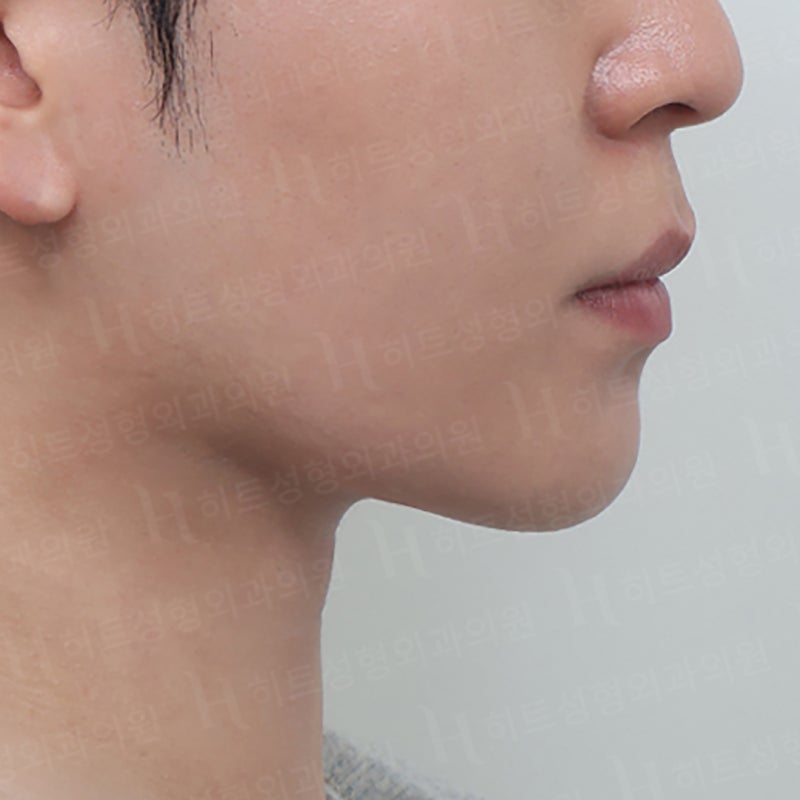 아이돌 얼굴형 만드는 얼굴지방흡입수술 사진 6