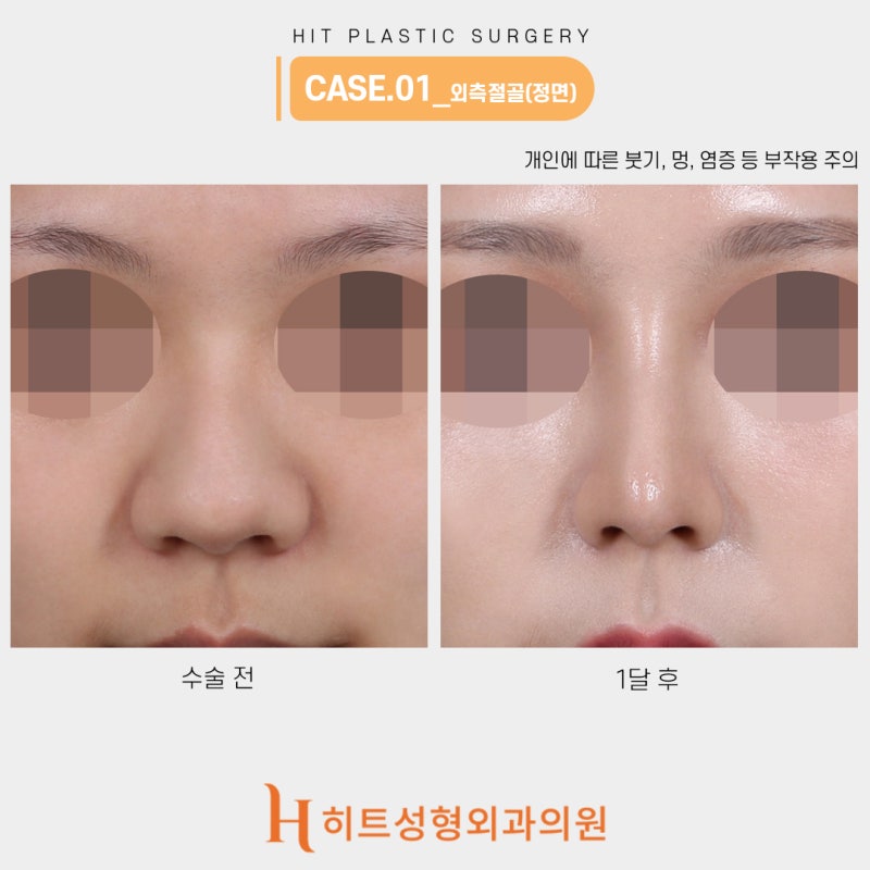 코절골술 휜코에 도움됩니다 사진 2