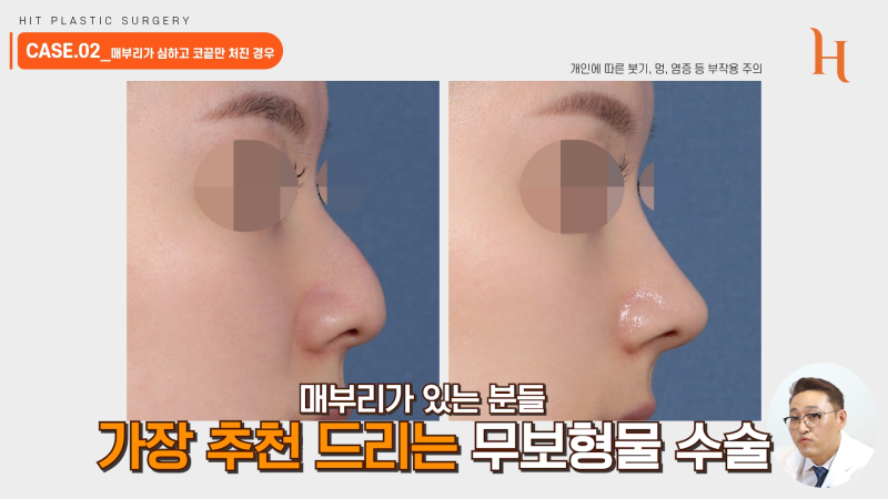 무보형물 코성형 성공하는 조건 사진 5