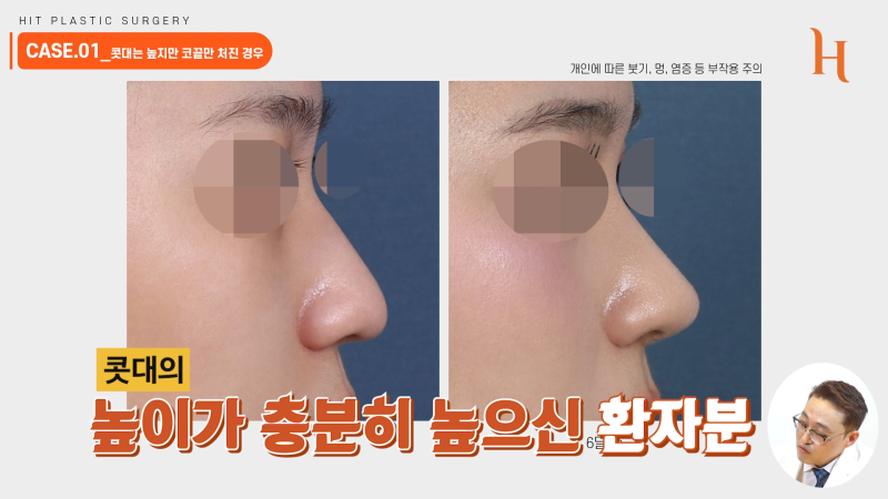 무보형물 코성형 성공하는 조건 사진 4