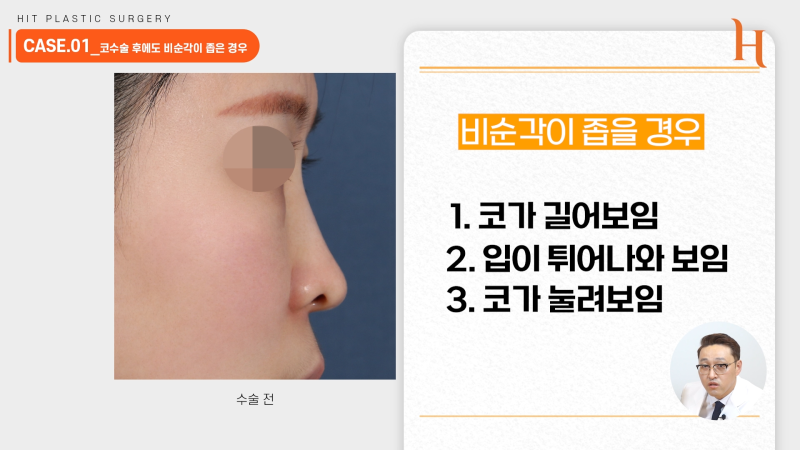비순각교정 중요한 이유 [히트성형외과] 사진 5