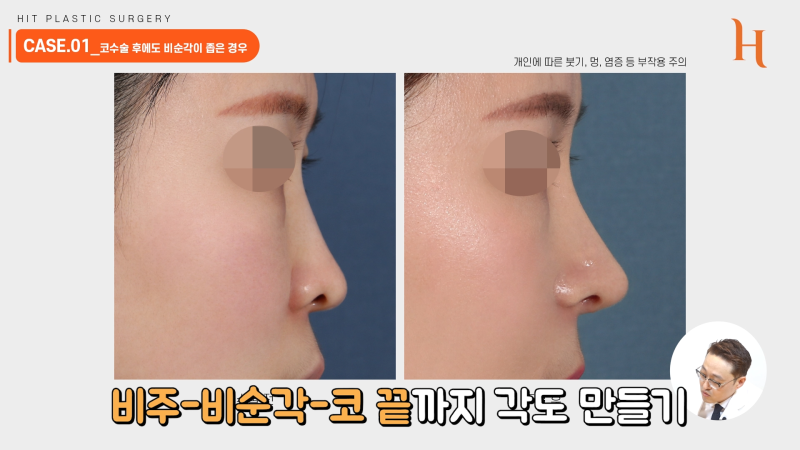 비순각교정 중요한 이유 [히트성형외과] 사진 6