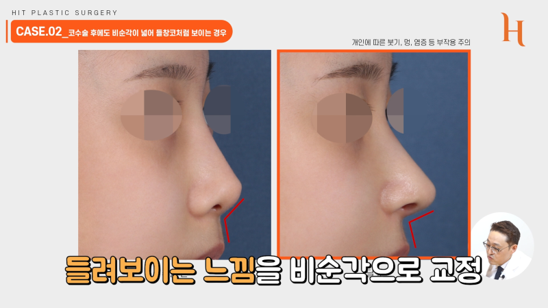 비순각교정 중요한 이유 [히트성형외과] 사진 8