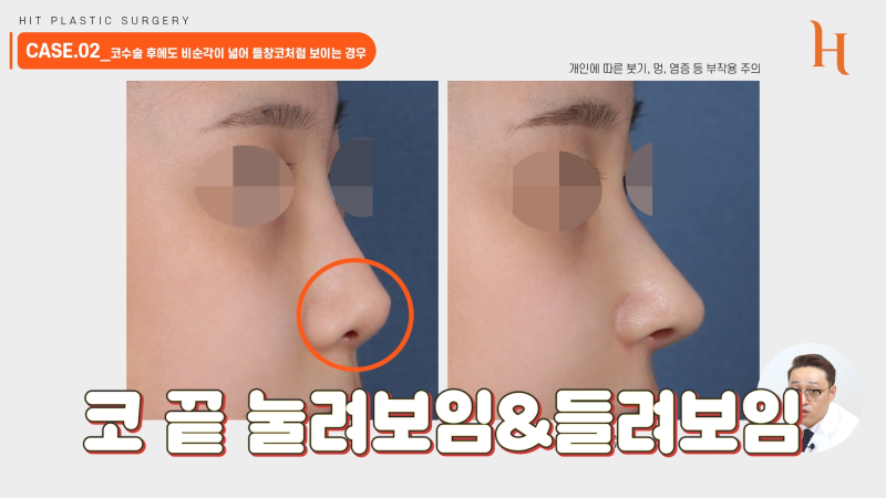 비순각교정 중요한 이유 [히트성형외과] 사진 7
