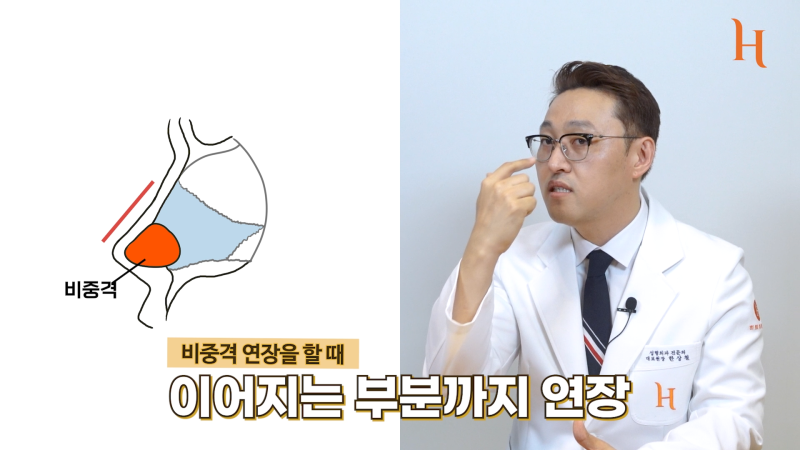 무보형물 코성형 방법이 궁금하다면 [히트성형외과] 사진 4