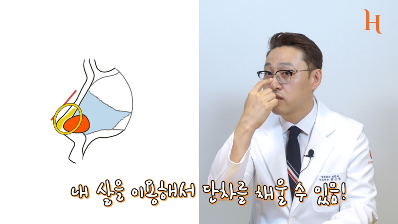 무보형물 코성형 방법이 궁금하다면 [히트성형외과] 사진 7