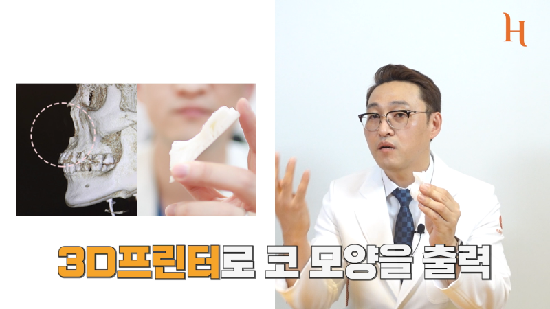 3D프린팅코성형으로 내 코에 딱 맞게 하자! 사진 3