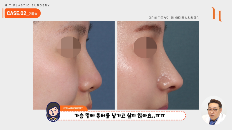 늑연골코수술 재료에 따라 차이가 있을까? 사진 7