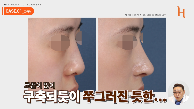 늑연골코수술 재료에 따라 차이가 있을까?