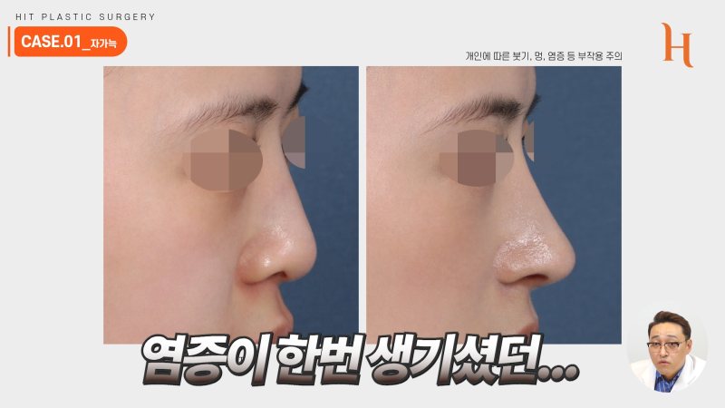 늑연골코수술 재료에 따라 차이가 있을까? 사진 3