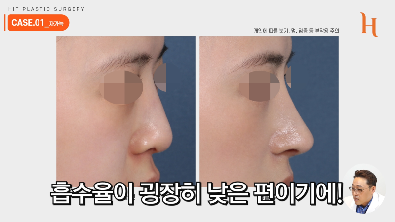 늑연골코수술 재료에 따라 차이가 있을까? 사진 5