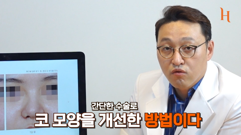 복코성형 콧볼축소만 해도 효과적 [히트성형외과] 사진 8