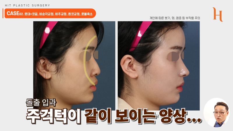 주걱턱 양악수술 안해도 개선된다 사진 9