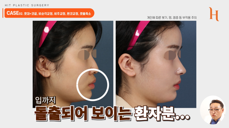 주걱턱 양악수술 안해도 개선된다 사진 8