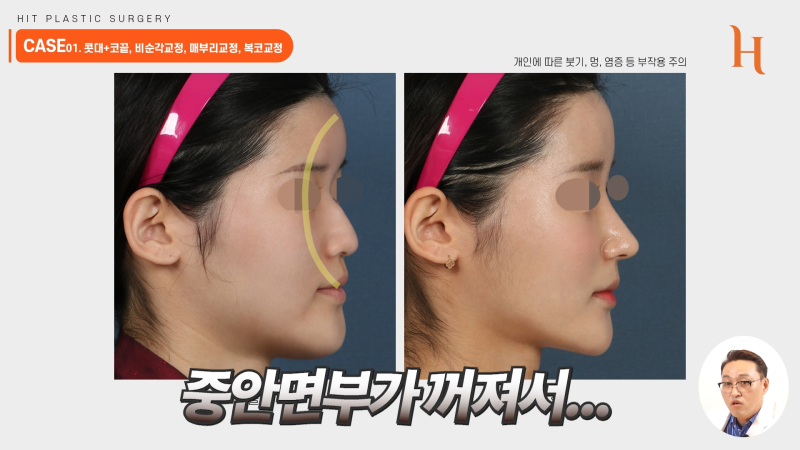 주걱턱 양악수술 안해도 개선된다 사진 6