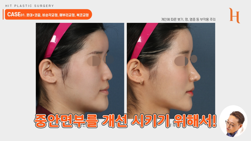 주걱턱 양악수술 안해도 개선된다 사진 7